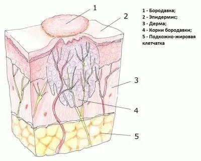 Бородавка под микроскопом фото